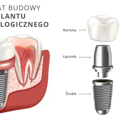 Schemat budowy implantu stomatologicznego. Dowiedz się, ile kosztuje implant zęba, poznając jego elementy: śrubę, łącznik i koronę.