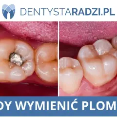 Porównanie zęba ze starą plombą amalgamatową i zęba po wypełnieniu.