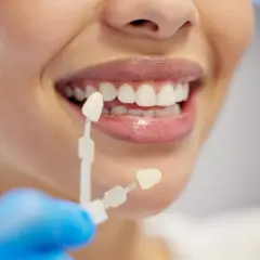 Dobieranie koloru licówek do naturalnych zębów. Na ile zębów zakłada się licówki? Decyzja należy do pacjenta i dentysty.