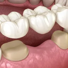 Model protetycznego mostu dentystycznego na zębach.
