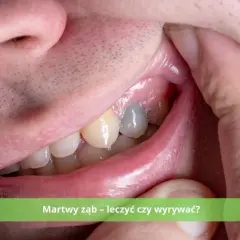 Martwy ząb: leczyć czy usunąć? Co wybrać? Koszty i zdrowie