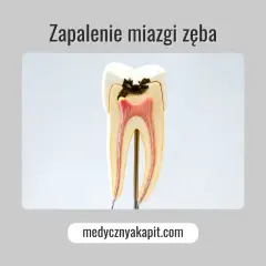 Przekrój zęba ukazujący próchnicę sięgającą do miazgi zęba, która jest zaczerwieniona i zaogniona.