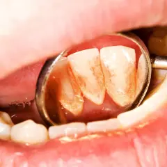 Widok zęba z widocznym kamieniem, odbitym w lusterku dentystycznym.