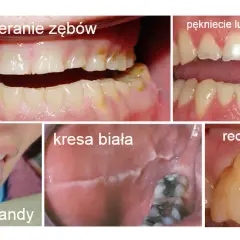 Płacz i zgrzytanie zębów: Czy bruksizm niszczy Twoje zęby?