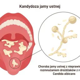 Ilustracja przedstawia jamę ustną z białymi nalotami na języku i podniebieniu, objawy grzybicy jamy ustnej. Powiększony fragment ukazuje drożdżaki Candida albicans.