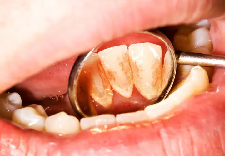 Widok zęba z widocznym kamieniem, odbitym w lusterku dentystycznym.
