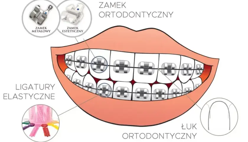 Kiedy założyć aparat na zęby? Wiek, warunki i proces krok po kroku