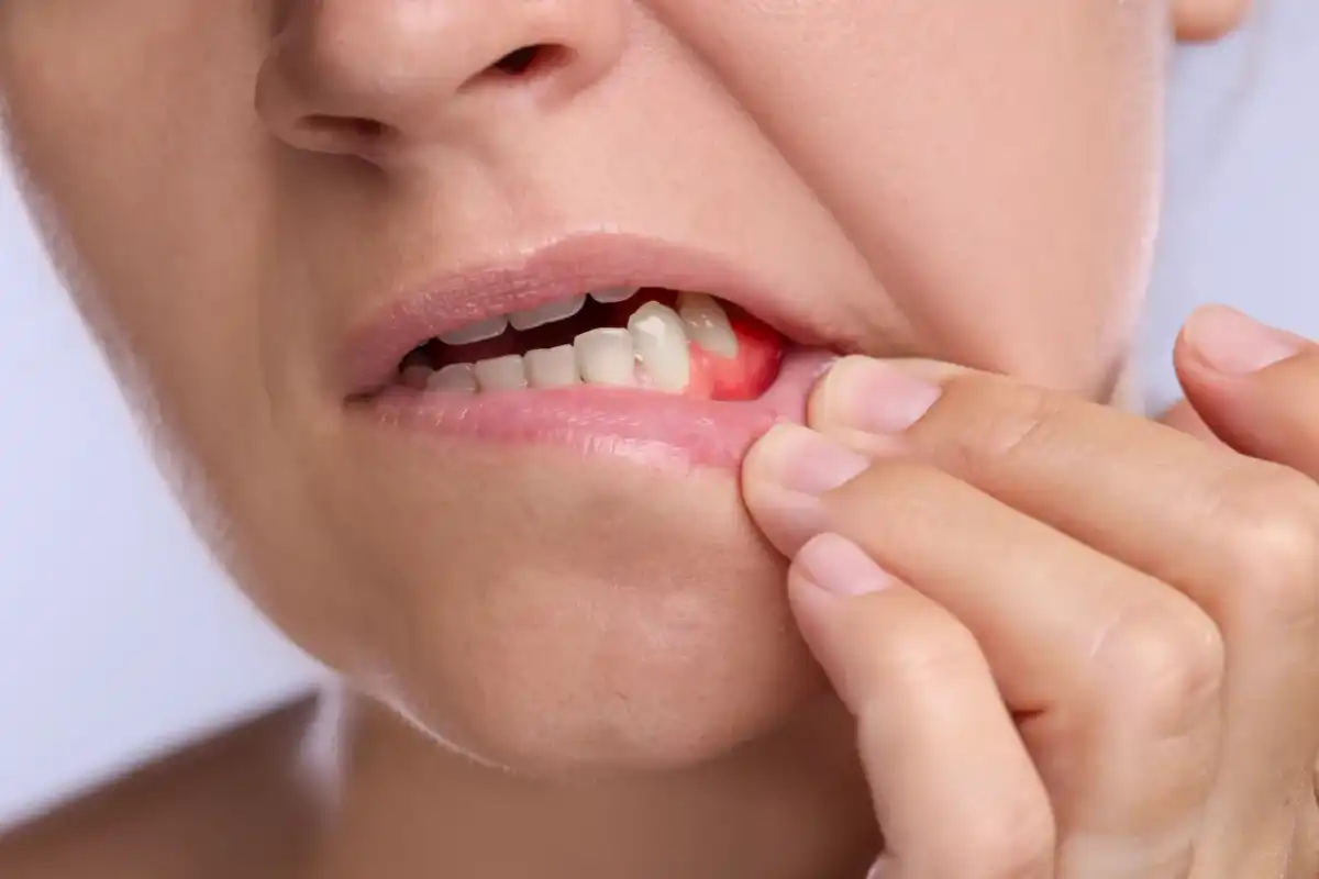 Zapalenie dziąseł - objawy, domowe kroki i kiedy do dentysty