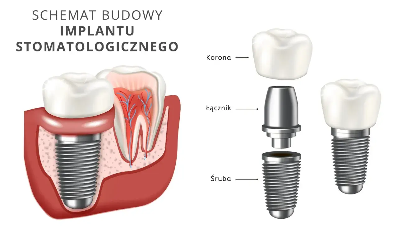 Schemat budowy implantu stomatologicznego. Dowiedz się, ile kosztuje implant zęba, poznając jego elementy: śrubę, łącznik i koronę.