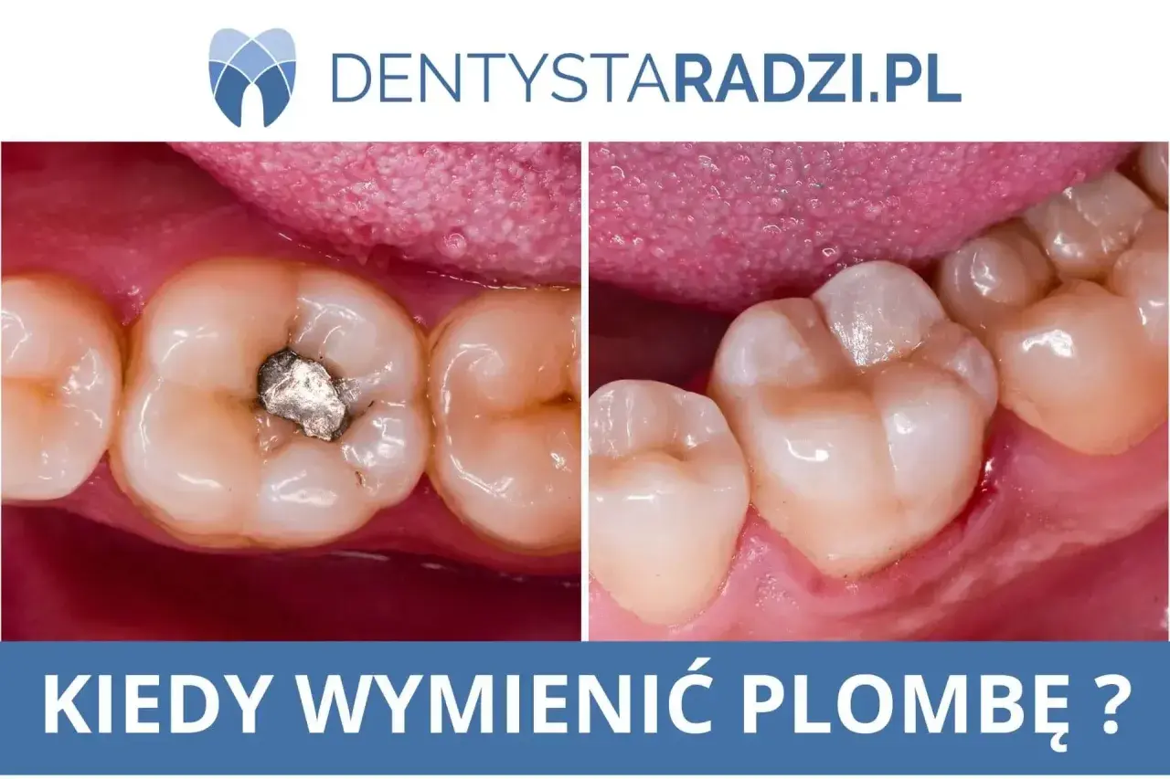 Porównanie zęba ze starą plombą amalgamatową i zęba po wypełnieniu.