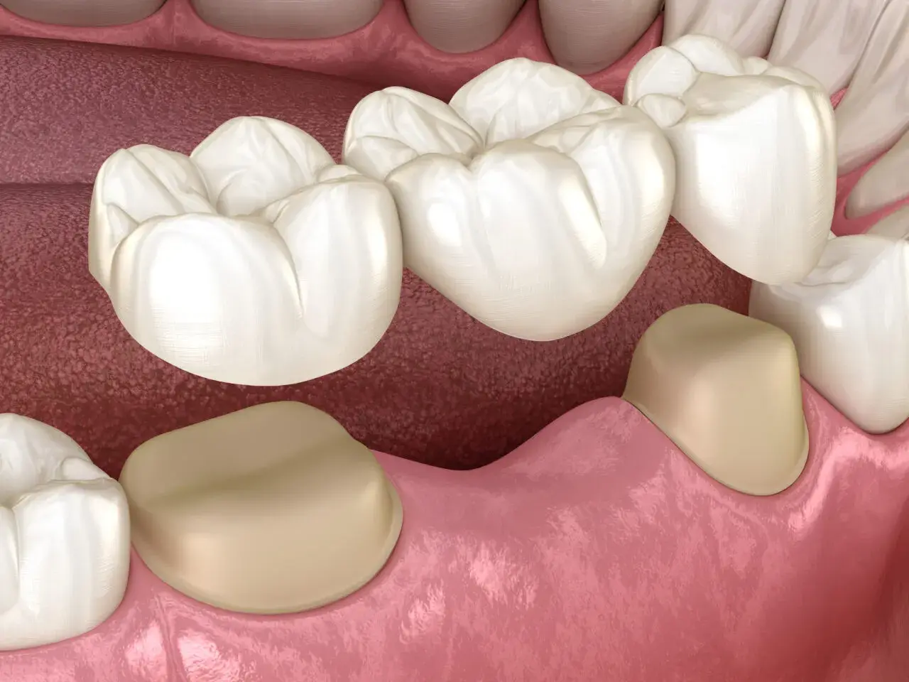 Model protetycznego mostu dentystycznego na zębach.
