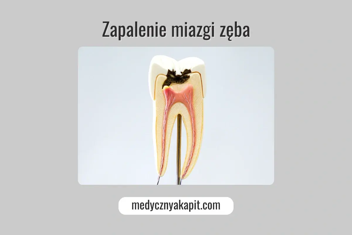 Przekrój zęba ukazujący próchnicę sięgającą do miazgi zęba, która jest zaczerwieniona i zaogniona.