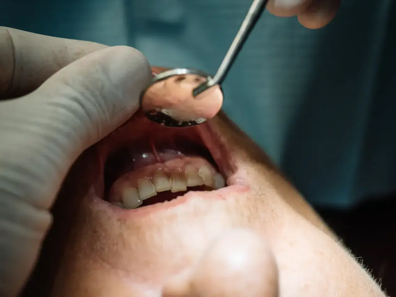 Dentysta bada zęby, być może przepisze antybiotyk na zęba, by zwalczyć infekcję.