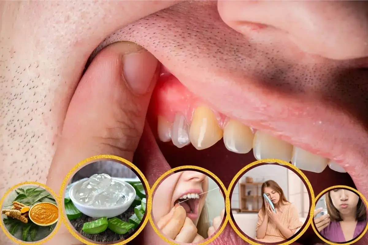 Zapalenie dziąseł? Zobacz naturalne sposoby i antybiotyk na zapalenie dziąseł bez recepty. Aloes, kurkuma, nić dentystyczna i ulga w bólu.