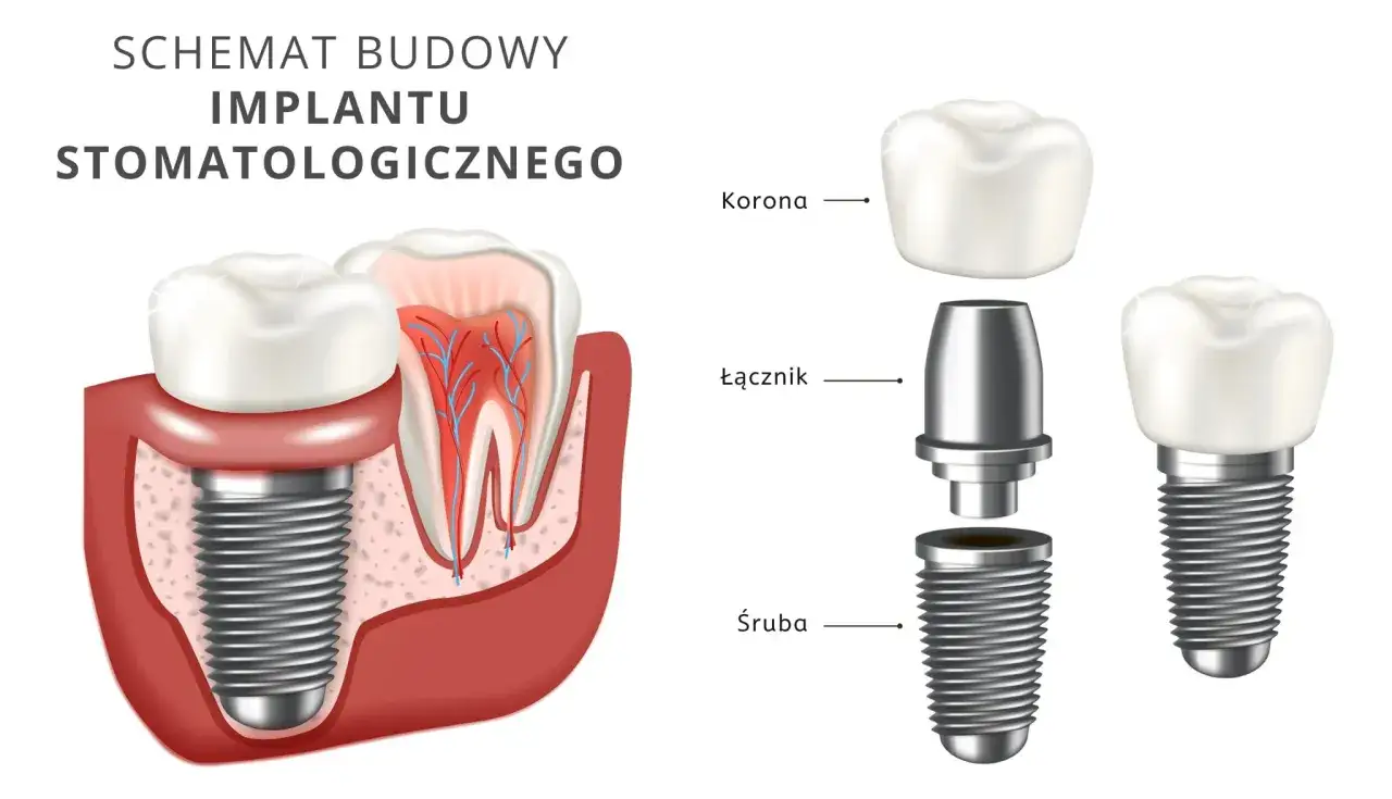 Schemat budowy implantu stomatologicznego. Dowiedz się, ile kosztuje implant zęba i jak jest zbudowany: śruba, łącznik, korona.