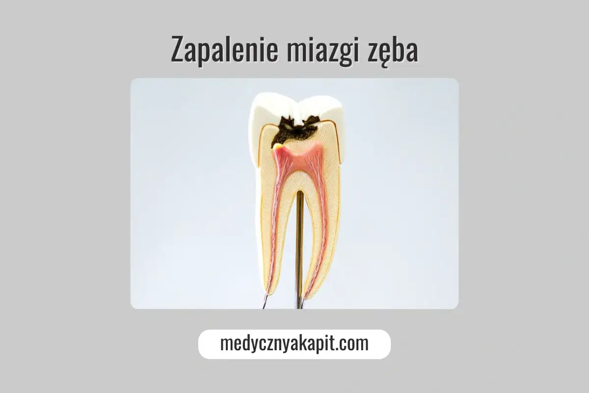 Model zęba ukazujący próchnicę sięgającą miazgi, co prowadzi do zapalenia miazgi.